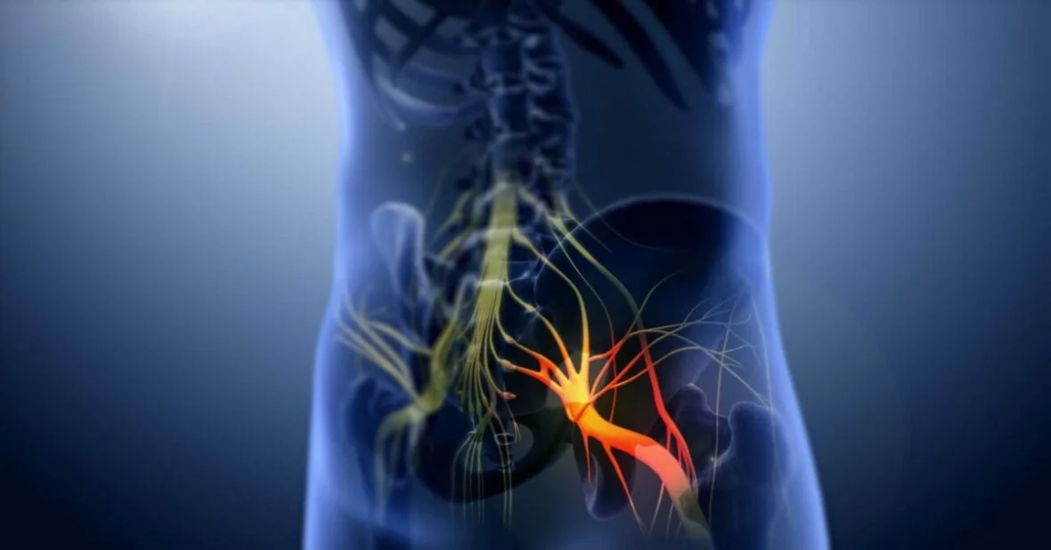 How To Treat Sciatica Naturally